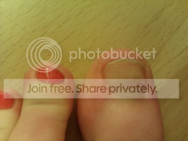 Ongle fendu Beauté des ongles FORUM Beauté Club.doctissimo.fr — free download